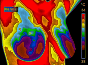 Breast Thermography at Cedar Wood Natural Health Center