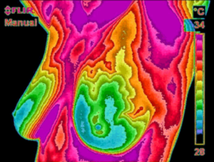 Breast Thermography at Cedar Wood Natural Health Center